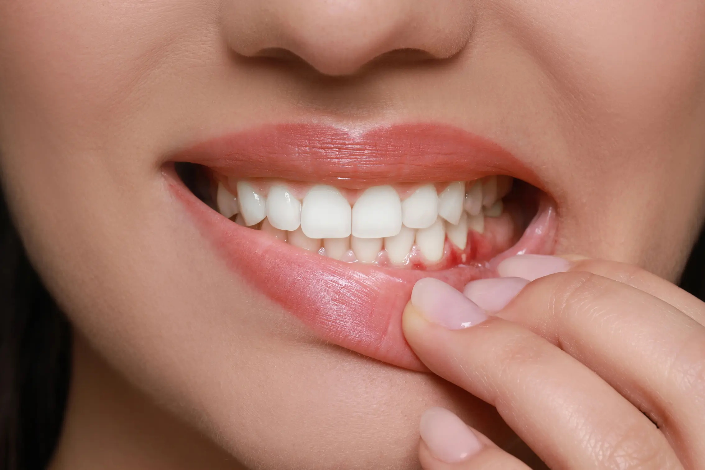 Bleeding Gums Treatment in Bangalore - Ridgetop Dental International