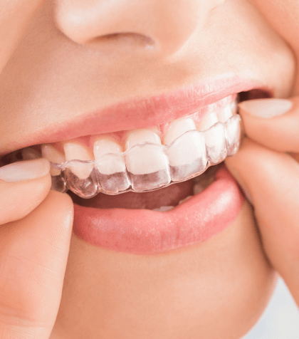 Invisalign Braces