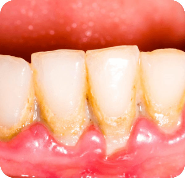 Have plaque or tartar buildup?