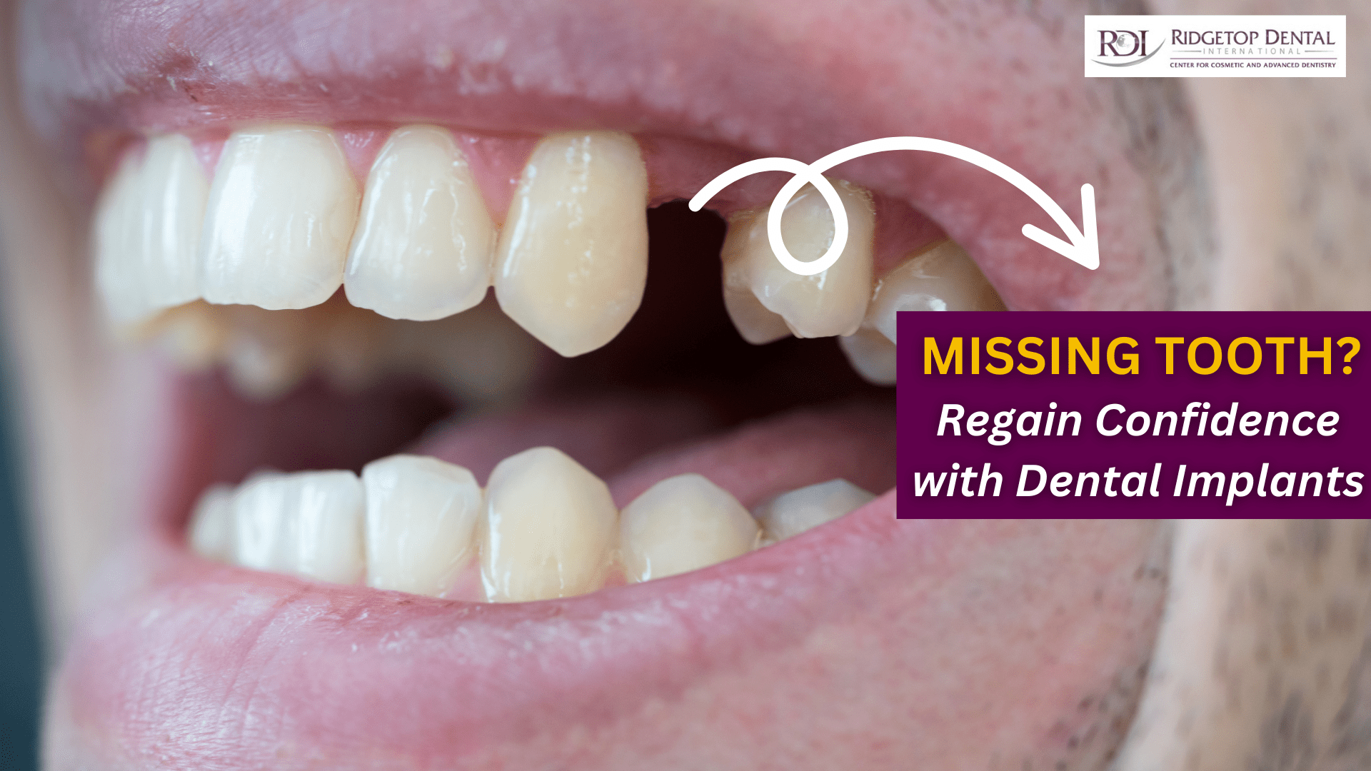 Missing Teeth? Regain Your Confidence & Chewing Power with Ridgetop Dental’s Advanced Solutions
